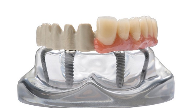 Invibio Dental implant prosthetic framework